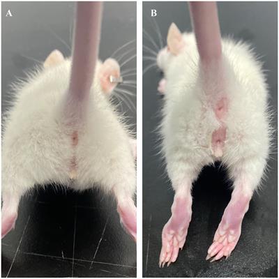 Acupoint catgut embedding: a potential intervention strategy for obesity-related precocious puberty